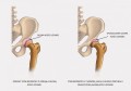 Orteza biodrowa z zegarem biodrowym AM-SB 1R -  4KIDS.jpg