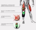 Militarna bioniczna orteza kolana RAPTOR BIONIC 4ARMY      -     REH4MAT.jpg